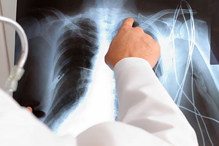 Product liability attorneys in Normal There are local Normal dangerous product attorneys who can sue the manufacturer.